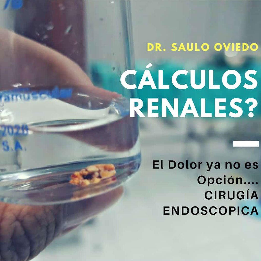 Tratamiento de Cálculos Renales